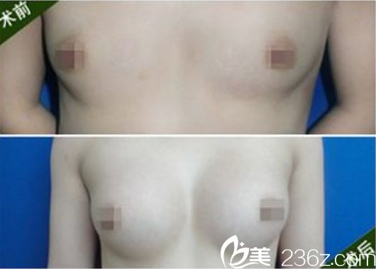 蘭州亞韓徐隴豫隆胸整形案例