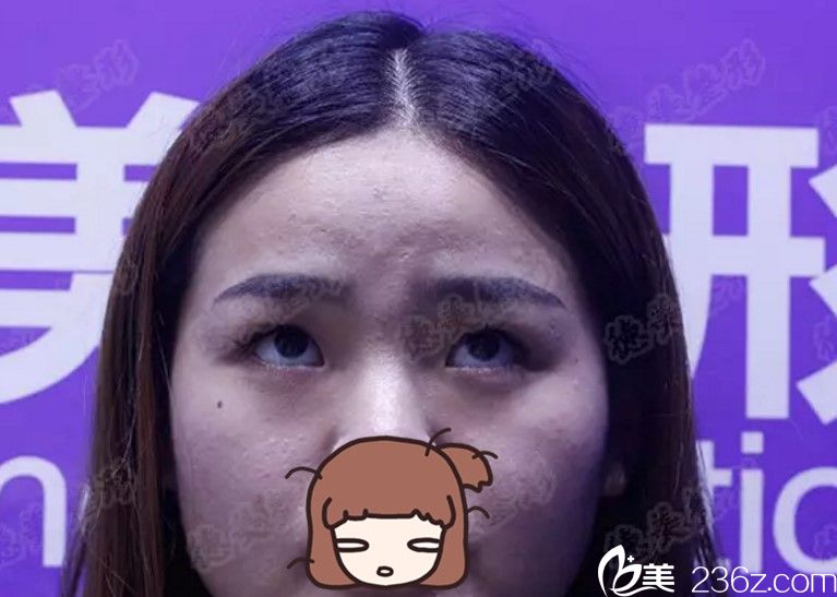 術(shù)前正面照 術(shù)前正面照