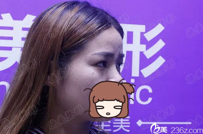 術(shù)前側(cè)面照 術(shù)前側(cè)面照