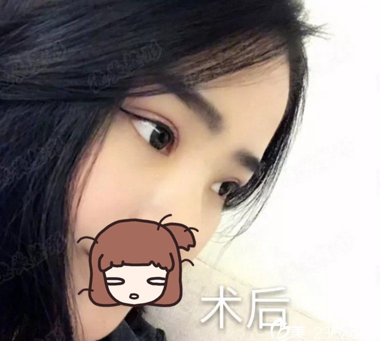 術(shù)后2個月 術(shù)后2個月