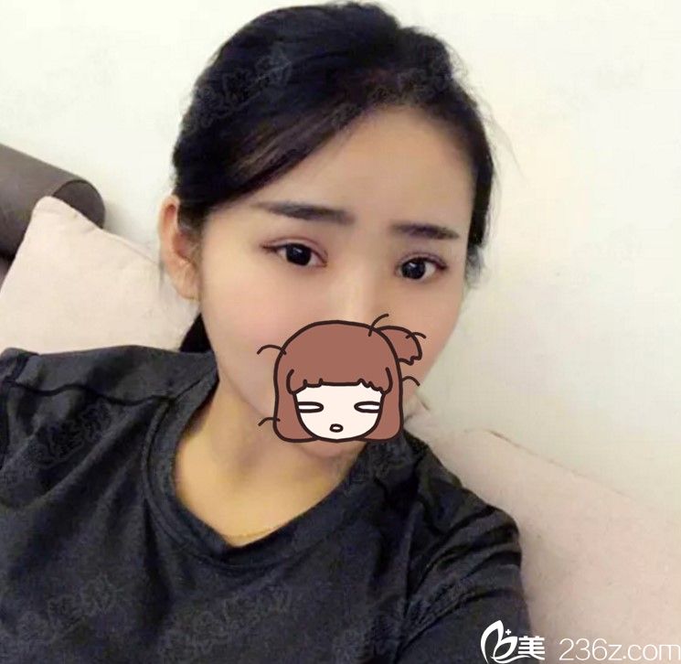 術(shù)后2個月正面 術(shù)后2個月正面