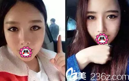 在南寧韓星做眼鼻綜合+自體脂肪填充全臉術(shù)后2個月 在南寧韓星做眼鼻綜合+自體脂肪填充全臉術(shù)后2個月