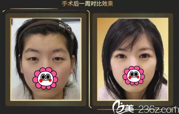 張東波醫(yī)生雙眼皮案例