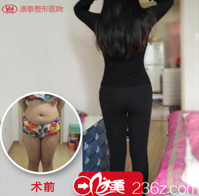 湛江澳泰整形醫(yī)院吸脂案例對比圖 湛江澳泰整形醫(yī)院吸脂案例對比圖