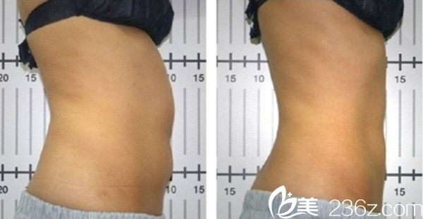 柳在<!--<i data=20240703-sp></i>-->長吸脂手術(shù)案例 柳在<!--<i data=20240703-sp></i>-->長吸脂手術(shù)案例