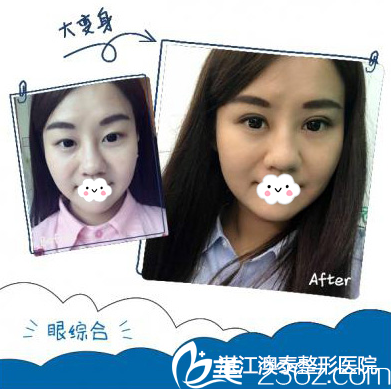 湛江澳泰整形醫(yī)院雙眼皮案例對比圖 湛江澳泰整形醫(yī)院雙眼皮案例對比圖