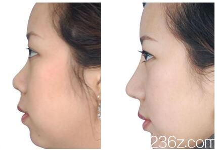 湛江澳泰整形醫(yī)院隆鼻案例 湛江澳泰整形醫(yī)院隆鼻案例