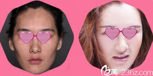 溫州芘麗芙自體脂肪填充案例 溫州芘麗芙自體脂肪填充案例