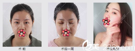 劉翠竹玻尿酸隆鼻和填充全臉案例 劉翠竹玻尿酸隆鼻和填充全臉案例