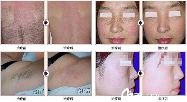 溫州芘麗芙薛媛醫(yī)生激光美膚案例 溫州芘麗芙薛媛醫(yī)生激光美膚案例