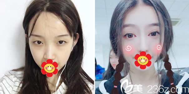 溫州芘麗芙金鋒醫(yī)生眼鼻手術(shù)代表案例 溫州芘麗芙金鋒醫(yī)生眼鼻手術(shù)代表案例