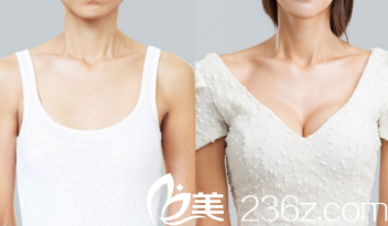 胸部整形前后對比 胸部整形前后對比