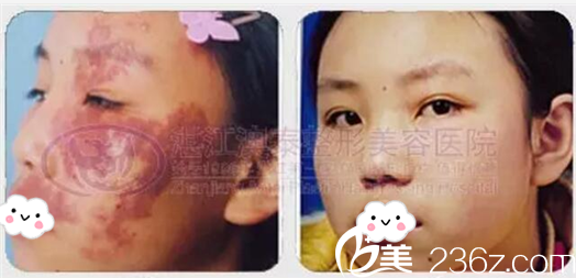 湛江澳泰整形醫(yī)院曾兆舜胎記祛除案例