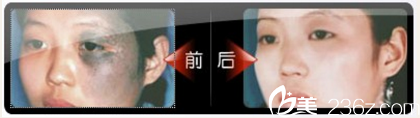 湛江澳泰整形醫(yī)院曾兆舜太田痣案例