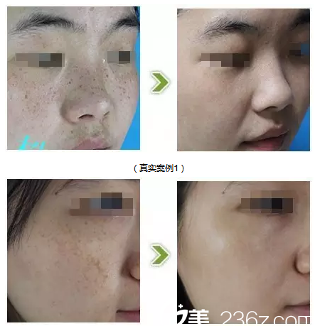 湛江澳泰整形醫(yī)院曾兆舜雀斑治療案例