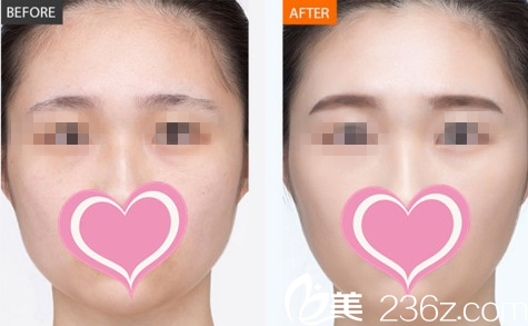 面部年輕化真人對(duì)比