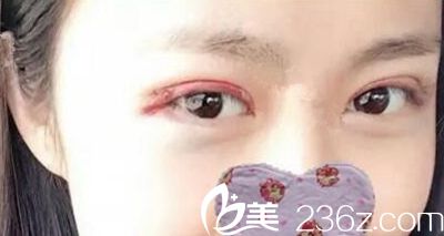 鄭州一美雙眼皮手術(shù)當(dāng)天 鄭州一美雙眼皮手術(shù)當(dāng)天