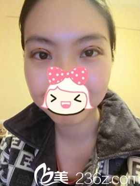 鄭州一美雙眼皮手術(shù)后3天 鄭州一美雙眼皮手術(shù)后3天