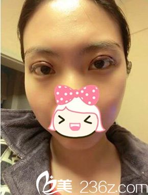 一美雙眼皮手術(shù)后第三天 一美雙眼皮手術(shù)后第三天