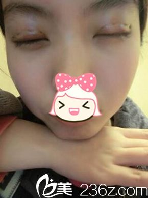 一美雙眼皮手術(shù)后三天閉眼照 一美雙眼皮手術(shù)后三天閉眼照