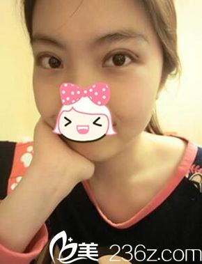 我去鄭州一美割了雙眼皮 術(shù)后效果大家來(lái)看看