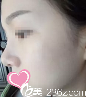 術后側顏效果 術后側顏效果