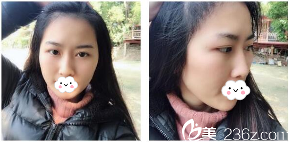 看我找廣州有名的倍生植發(fā)醫(yī)院廖駿做的發(fā)際線種植效果好不好