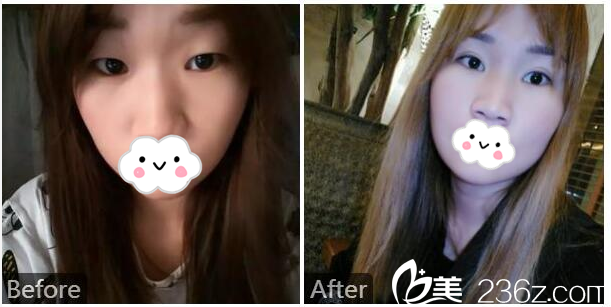 深圳美萊徐占鋒醫(yī)生做的雙眼皮案例 深圳美萊徐占鋒醫(yī)生做的雙眼皮案例