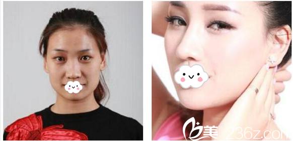 深圳美萊徐占鋒醫(yī)生隆鼻案例前后對比圖 深圳美萊徐占鋒醫(yī)生隆鼻案例前后對比圖