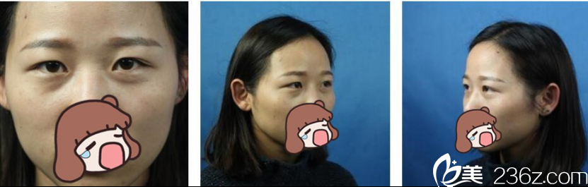 長沙美萊 雙眼皮開眼角案例 長沙美萊 雙眼皮開眼角案例