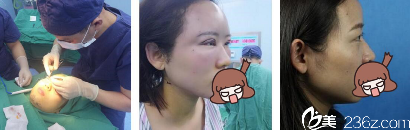 長沙美萊潘衛(wèi)峰自體脂肪面部填充案例 長沙美萊潘衛(wèi)峰自體脂肪面部填充案例