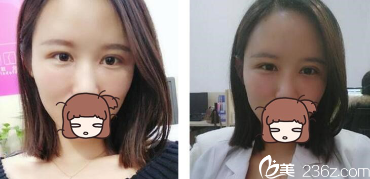 自體脂肪豐額頭+雙眼皮真人案例 自體脂肪豐額頭+雙眼皮真人案例