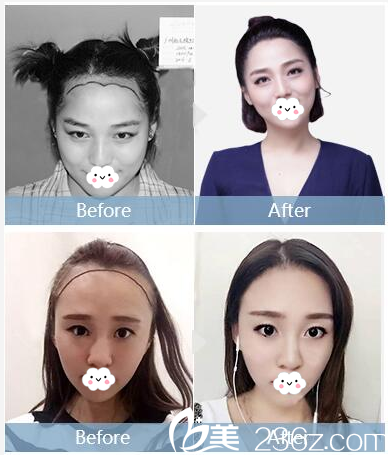 深圳<!--<i data=20240703-sp></i>-->植發(fā)醫(yī)院女士發(fā)際線種植 深圳<!--<i data=20240703-sp></i>-->植發(fā)醫(yī)院女士發(fā)際線種植