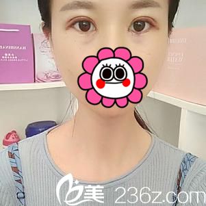 術(shù)后四天效果