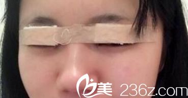 蘭州明倫雙眼皮整形天