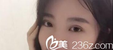 蘭州明倫整形馮建業(yè)醫(yī)生給我做的切開法雙眼皮好不好 大家?guī)臀诣b定一下