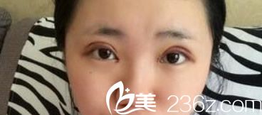 蘭州明倫雙眼皮整形天 明倫割雙眼皮第三天