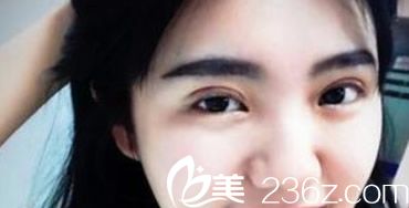 蘭州明倫雙眼皮第十天效果
