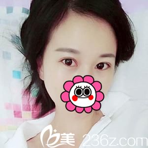 術(shù)后28天效果