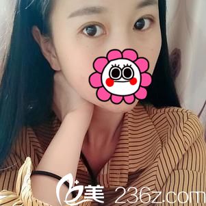 宜昌前衛(wèi)李傳榮院長切開雙眼皮+開內(nèi)眼角1個(gè)月恢復(fù)詳情報(bào)告
