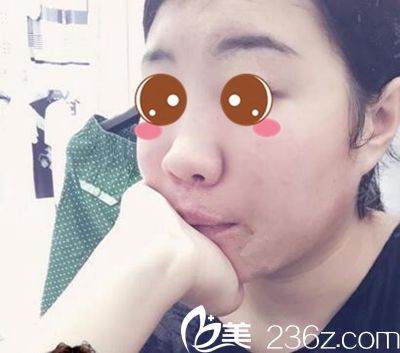 隆鼻手術(shù)前照片 隆鼻手術(shù)前照片