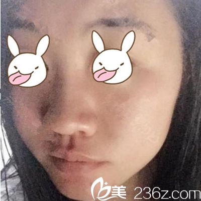 鄭州梨花雨隆鼻術(shù)前 鄭州梨花雨隆鼻術(shù)前