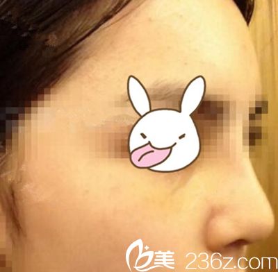 美鼻代言：商丘姑娘在鄭州梨花雨隆鼻變美記 