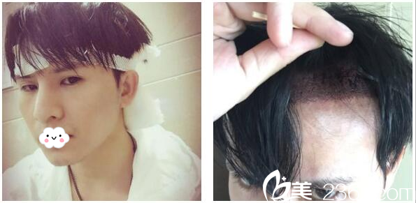 剛在深圳<!--<i data=20240703-sp></i>-->植發(fā)醫(yī)院植發(fā)完的樣子 剛在深圳<!--<i data=20240703-sp></i>-->植發(fā)醫(yī)院植發(fā)完的樣子