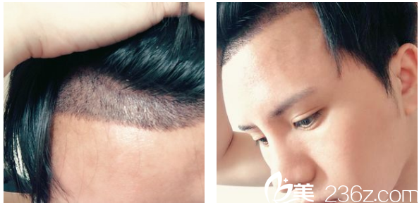 深圳<!--<i data=20240703-sp></i>-->植發(fā)6天發(fā)際線特寫圖 深圳<!--<i data=20240703-sp></i>-->植發(fā)6天發(fā)際線特寫圖