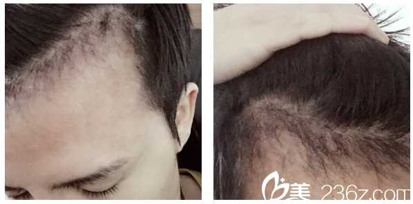 深圳<!--<i data=20240703-sp></i>-->植發(fā)發(fā)際線種植2個(gè)月恢復(fù)效果圖