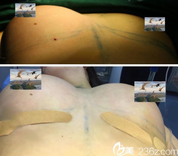 金華亞美薛磊自體脂肪隆胸過程