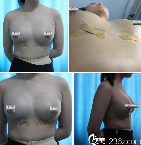 自體脂肪隆胸手術(shù)7天恢復(fù)照