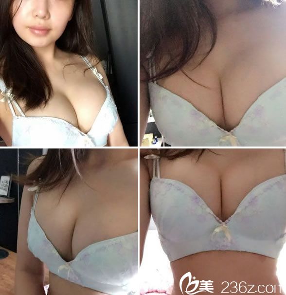 隆胸手術(shù)16天的恢復(fù)<span style=