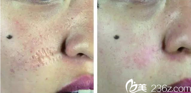疤痕修復(fù)案例2 疤痕修復(fù)案例2